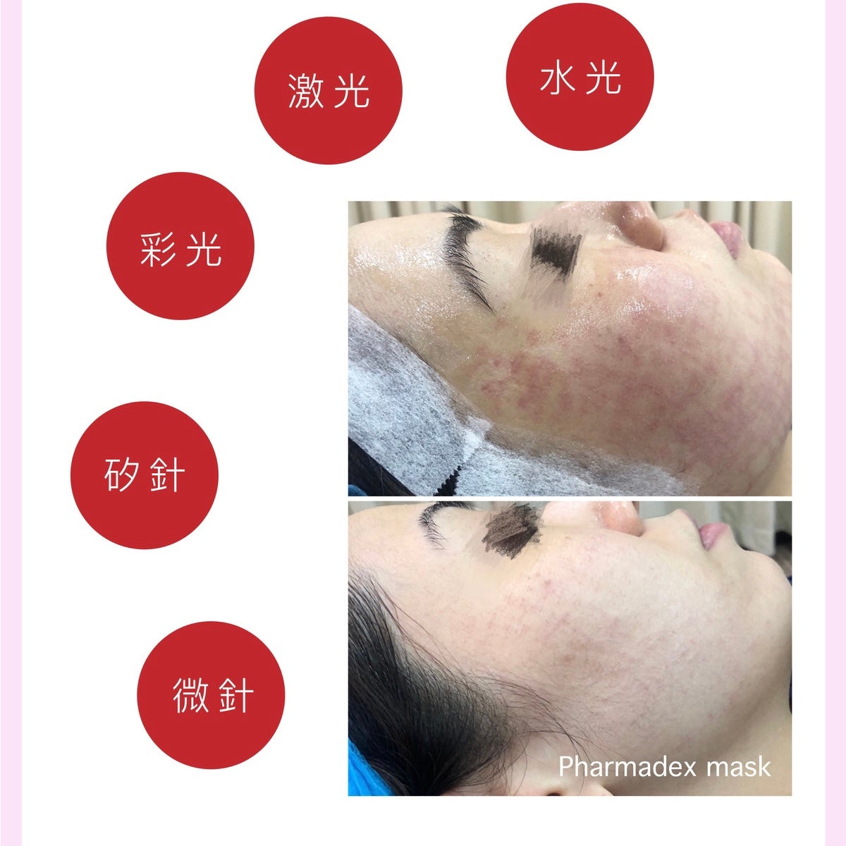 Pharmadex MSE退紅神奇面膜