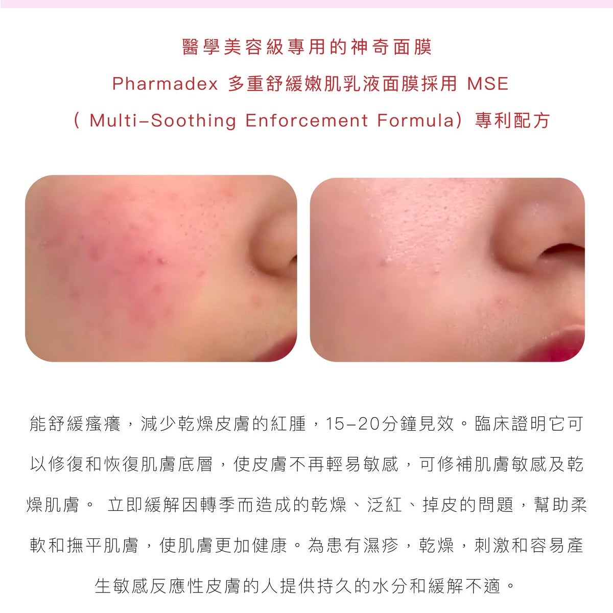 Pharmadex MSE退紅神奇面膜